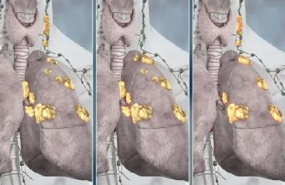 Metastaser i lymfkörtlarna överlevnad